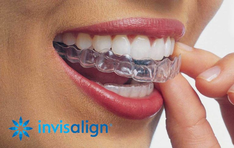 Invisalign® vs. Braces: Which is Better For You?